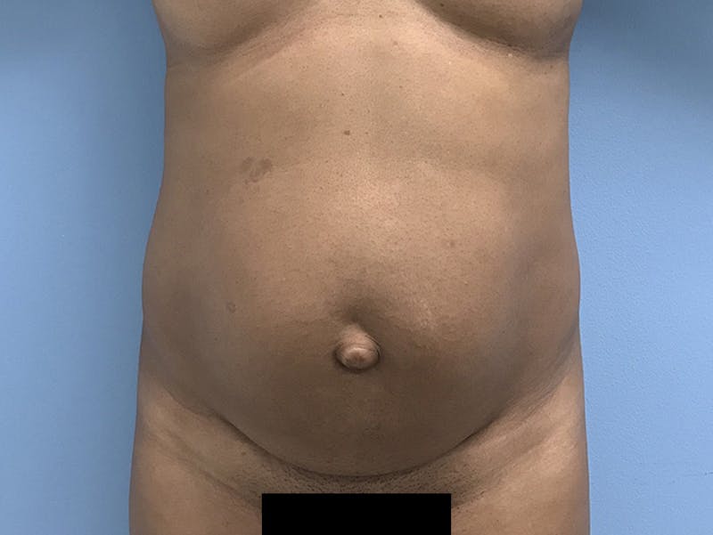 Tummy Tuck Before & After Gallery - Patient 120905402 - Image 1
