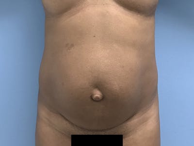 Tummy Tuck Before & After Gallery - Patient 120905402 - Image 1