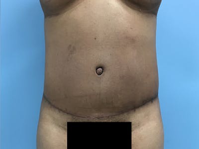 Tummy Tuck Before & After Gallery - Patient 120905402 - Image 2