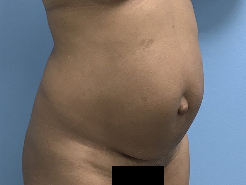 Tummy Tuck Before & After Gallery - Patient 120905402 - Image 3