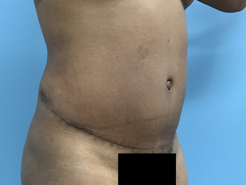 Tummy Tuck Before & After Gallery - Patient 120905402 - Image 4