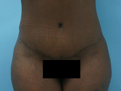 Tummy Tuck Before & After Gallery - Patient 120905417 - Image 2