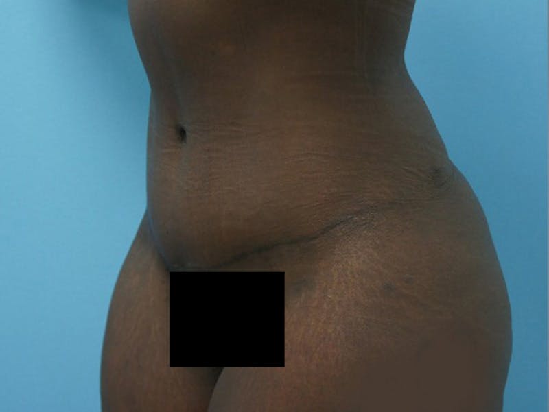Tummy Tuck Before & After Gallery - Patient 120905417 - Image 4