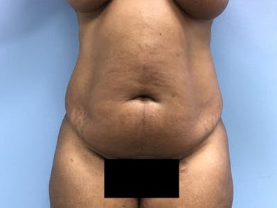 Tummy Tuck Before & After Gallery - Patient 120905428 - Image 1