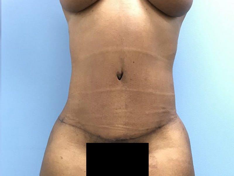 Tummy Tuck Before & After Gallery - Patient 120905428 - Image 2