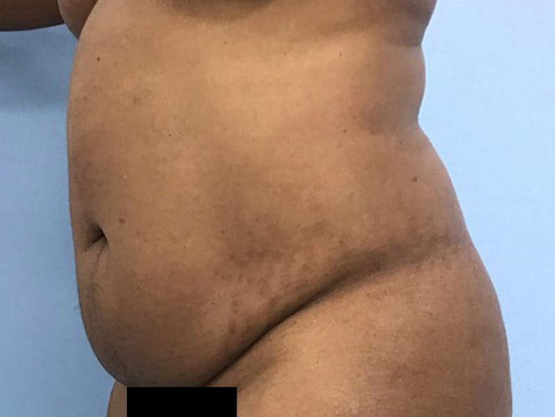 Tummy Tuck Before & After Gallery - Patient 120905428 - Image 7