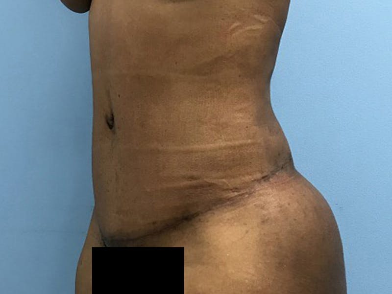 Tummy Tuck Before & After Gallery - Patient 120905428 - Image 8