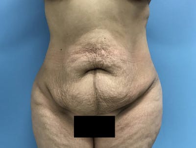 Tummy Tuck Before & After Gallery - Patient 120905446 - Image 1
