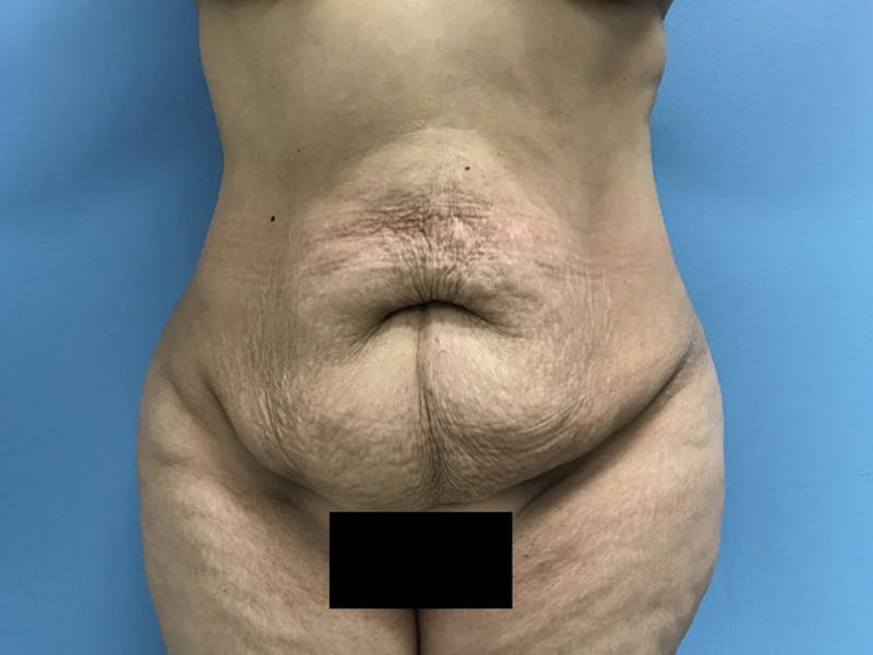 Tummy Tuck Before & After Gallery - Patient 120905446 - Image 1