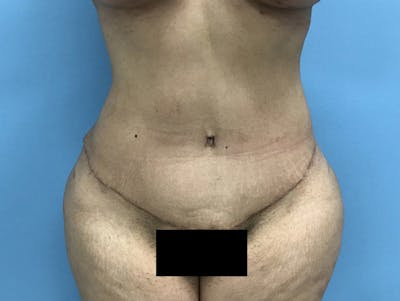 Tummy Tuck Before & After Gallery - Patient 120905446 - Image 2