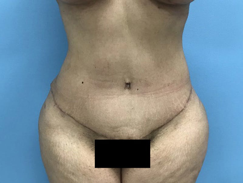 Tummy Tuck Before & After Gallery - Patient 120905446 - Image 2