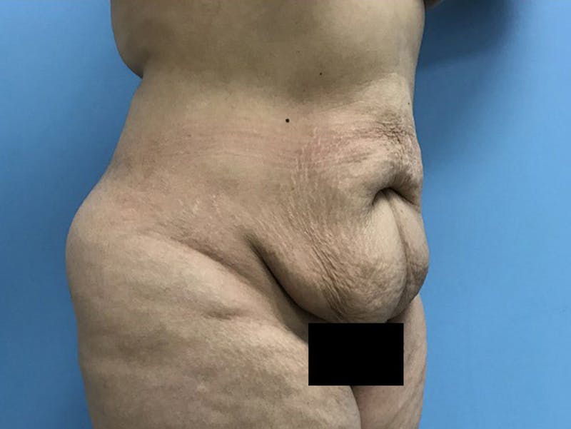 Tummy Tuck Before & After Gallery - Patient 120905446 - Image 3