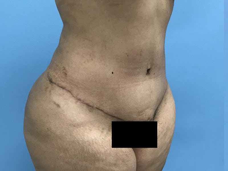 Tummy Tuck Before & After Gallery - Patient 120905446 - Image 4