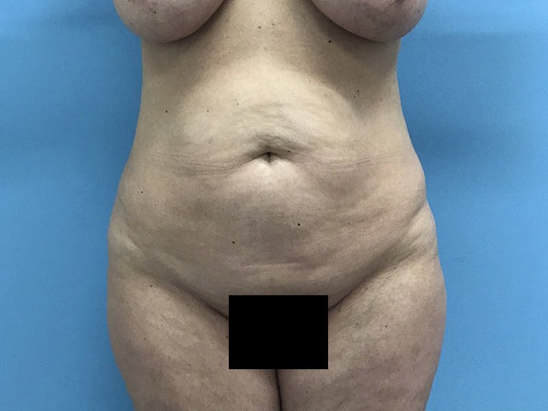 Tummy Tuck Before & After Gallery - Patient 120905468 - Image 1