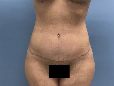 Tummy Tuck Before & After Gallery - Patient 120905468 - Image 2