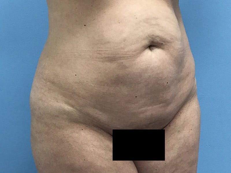 Tummy Tuck Before & After Gallery - Patient 120905468 - Image 5