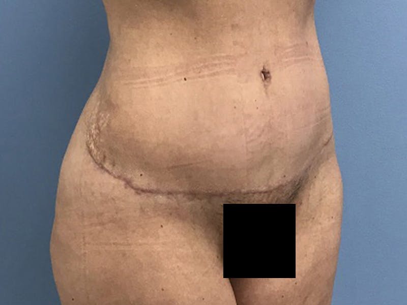 Tummy Tuck Before & After Gallery - Patient 120905468 - Image 6