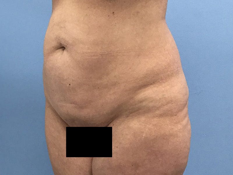 Tummy Tuck Before & After Gallery - Patient 120905468 - Image 9