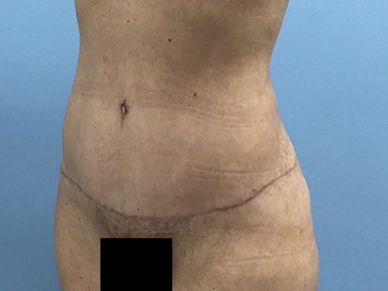 Tummy Tuck Before & After Gallery - Patient 120905468 - Image 10