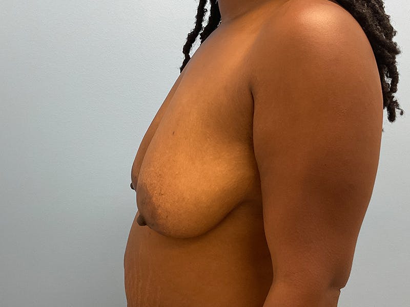 Breast Reduction Before & After Gallery - Patient 412264 - Image 5