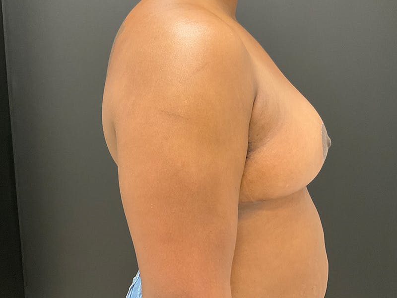 Breast Reduction Before & After Gallery - Patient 412264 - Image 8