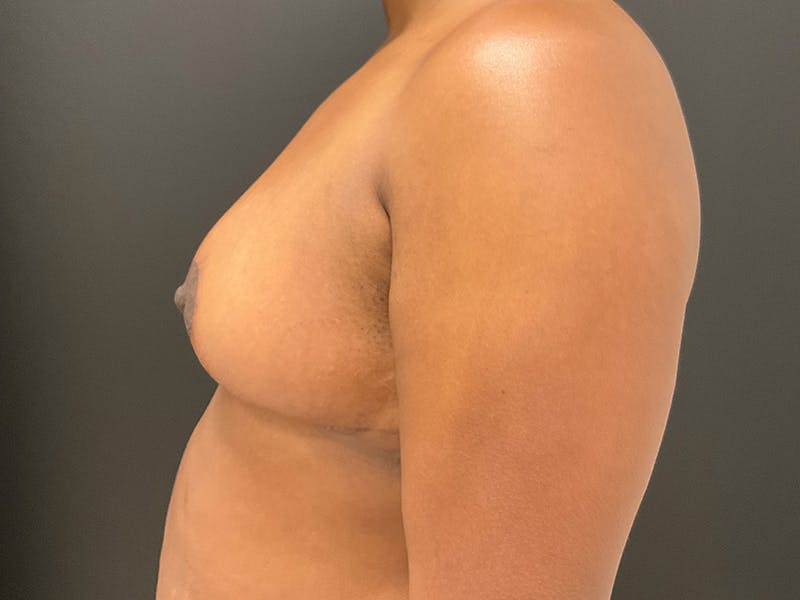 Breast Reduction Before & After Gallery - Patient 412264 - Image 6