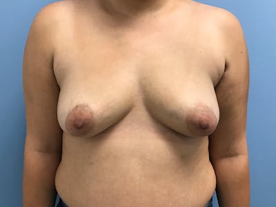 Breast Augmentation Before & After Gallery - Patient 130262 - Image 1