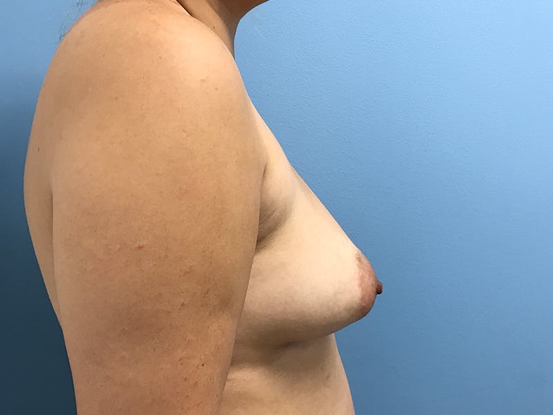 Breast Augmentation Before & After Gallery - Patient 130262 - Image 7