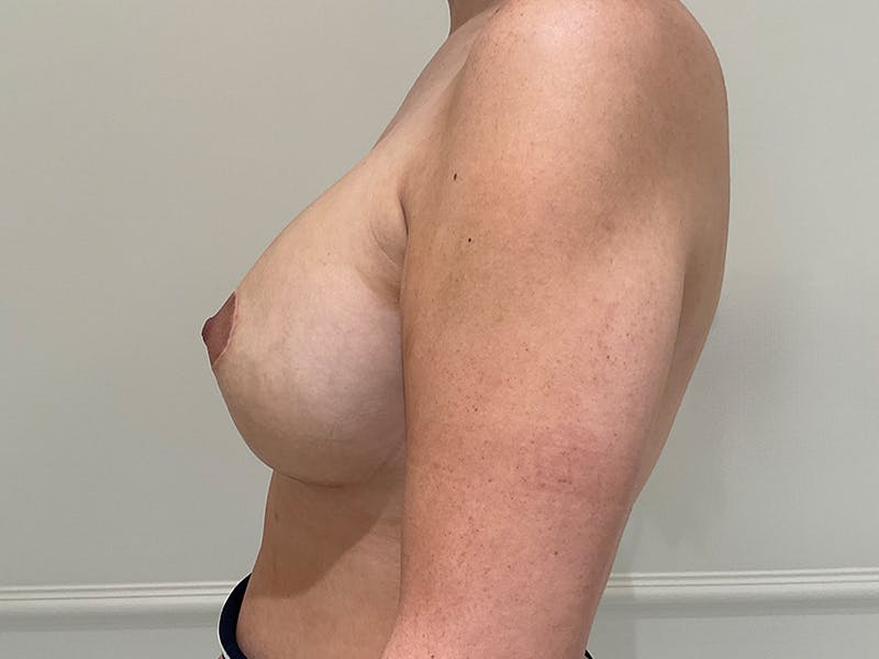 Breast Augmentation Before & After Gallery - Patient 130262 - Image 6