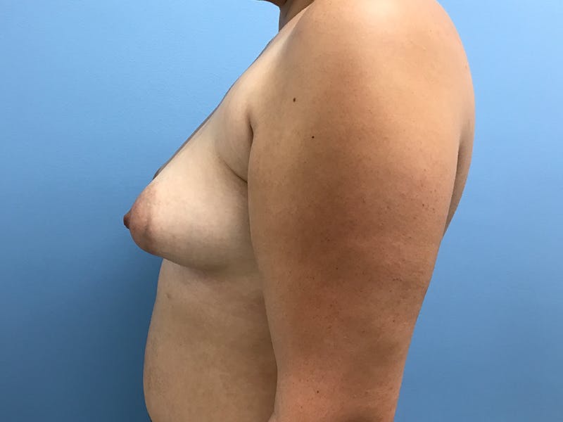 Breast Augmentation Before & After Gallery - Patient 130262 - Image 5