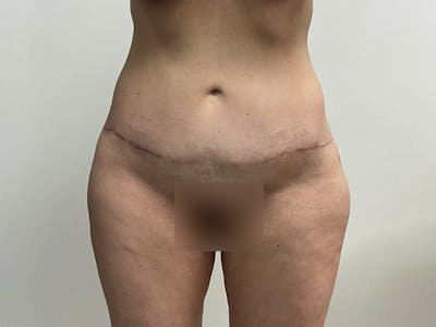 Liposuction Before & After Gallery - Patient 656148 - Image 2