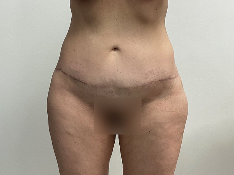 Tummy Tuck Before & After Gallery - Patient 281794 - Image 2