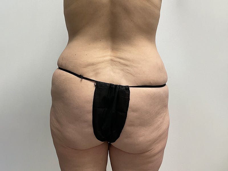Tummy Tuck Before & After Gallery - Patient 281794 - Image 3