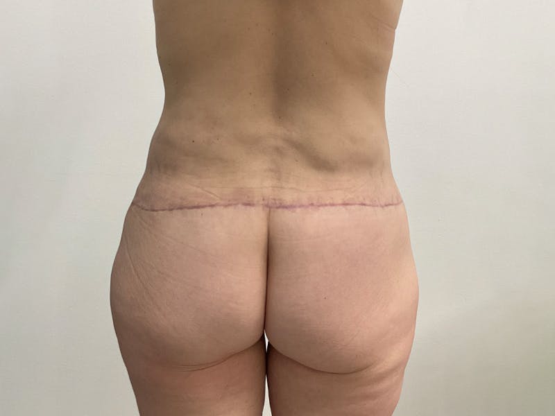 Tummy Tuck Before & After Gallery - Patient 281794 - Image 4