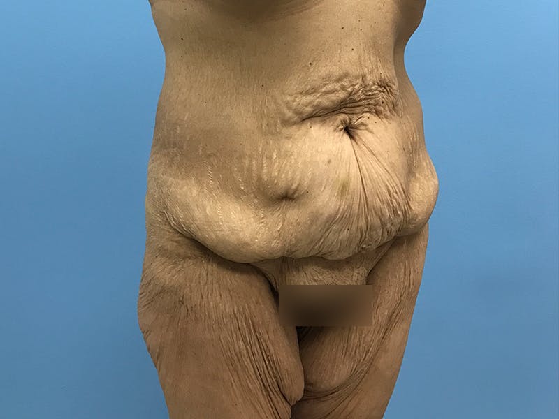 After Major Weight Loss Before & After Gallery - Patient 406566 - Image 1