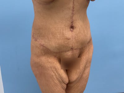 After Major Weight Loss Before & After Gallery - Patient 406566 - Image 2