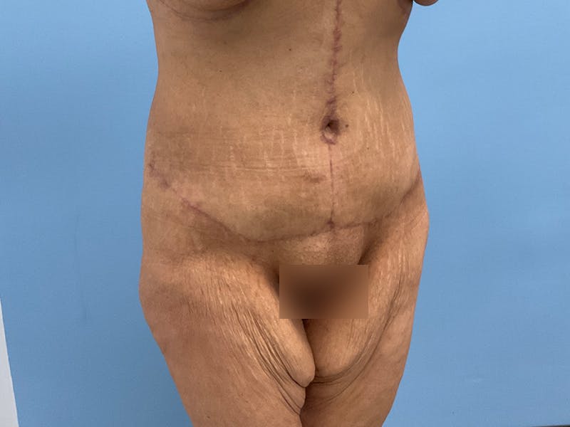 After Major Weight Loss Before & After Gallery - Patient 406566 - Image 2