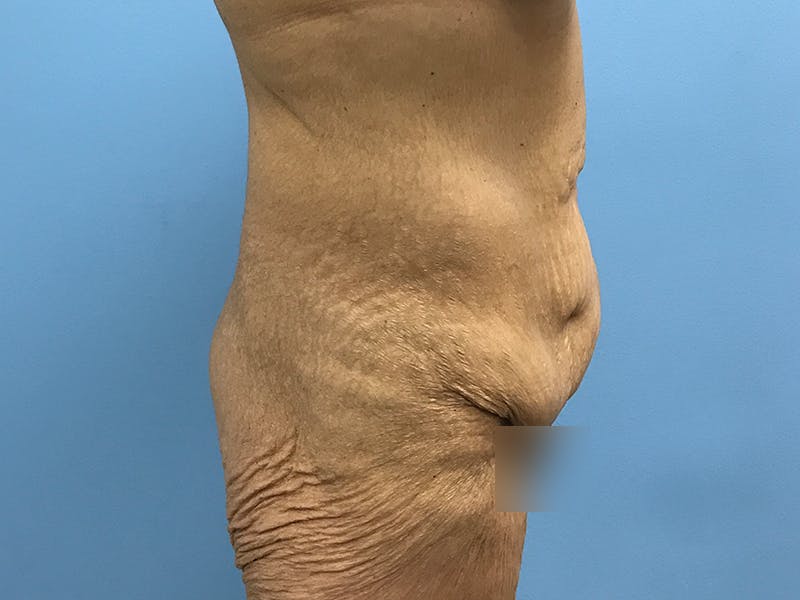 After Major Weight Loss Before & After Gallery - Patient 406566 - Image 3