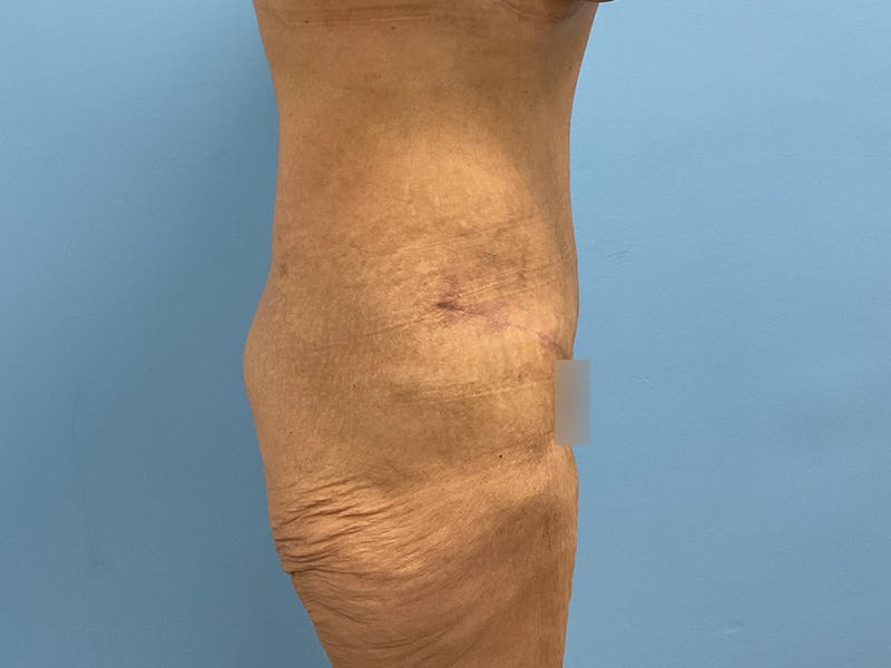After Major Weight Loss Before & After Gallery - Patient 406566 - Image 4