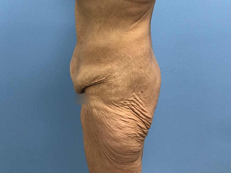 After Major Weight Loss Before & After Gallery - Patient 406566 - Image 5