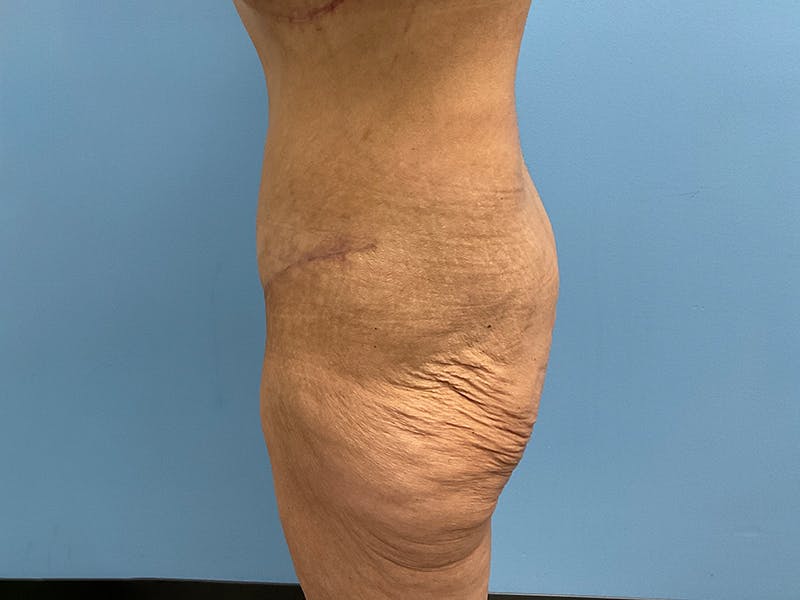 After Major Weight Loss Before & After Gallery - Patient 406566 - Image 6