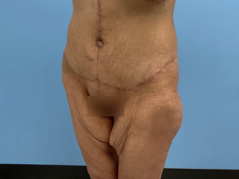 After Major Weight Loss Before & After Gallery - Patient 406566 - Image 8