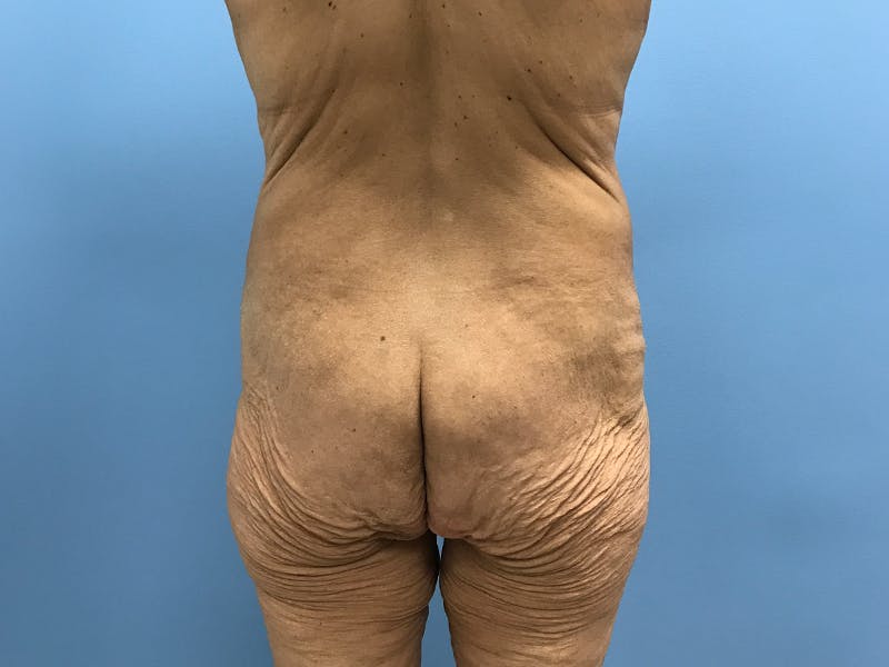 After Major Weight Loss Before & After Gallery - Patient 406566 - Image 9