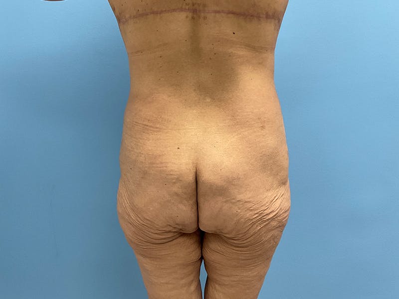 After Major Weight Loss Before & After Gallery - Patient 406566 - Image 10