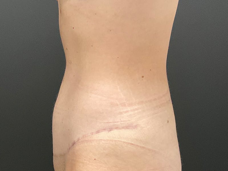 Tummy Tuck Before & After Gallery - Patient 318654 - Image 8