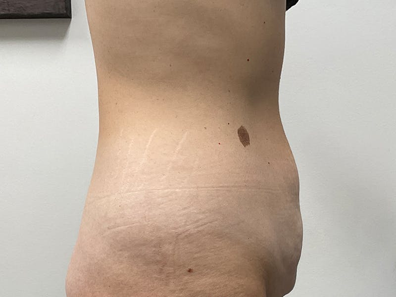 Tummy Tuck Before & After Gallery - Patient 318654 - Image 5