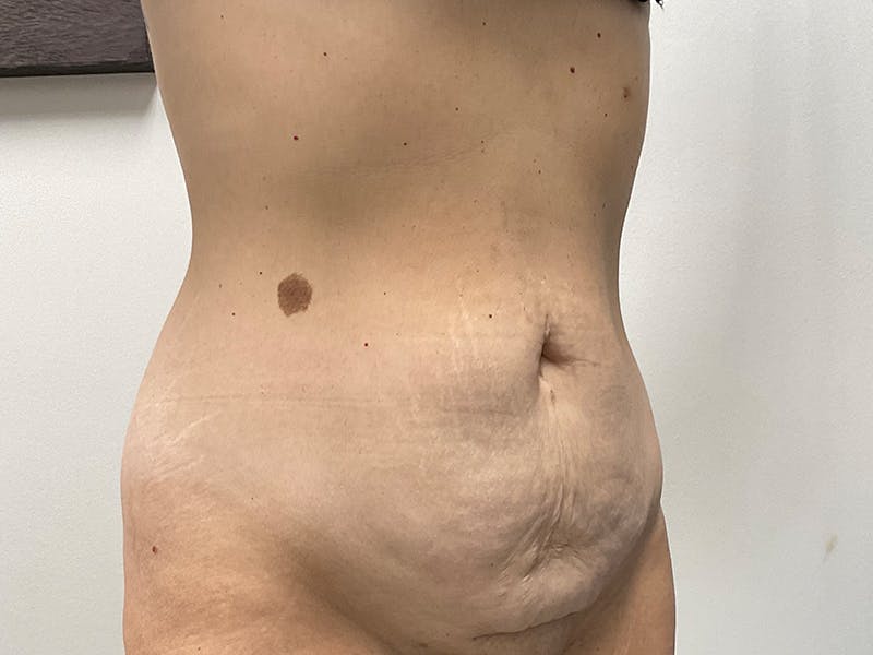 Tummy Tuck Before & After Gallery - Patient 318654 - Image 3