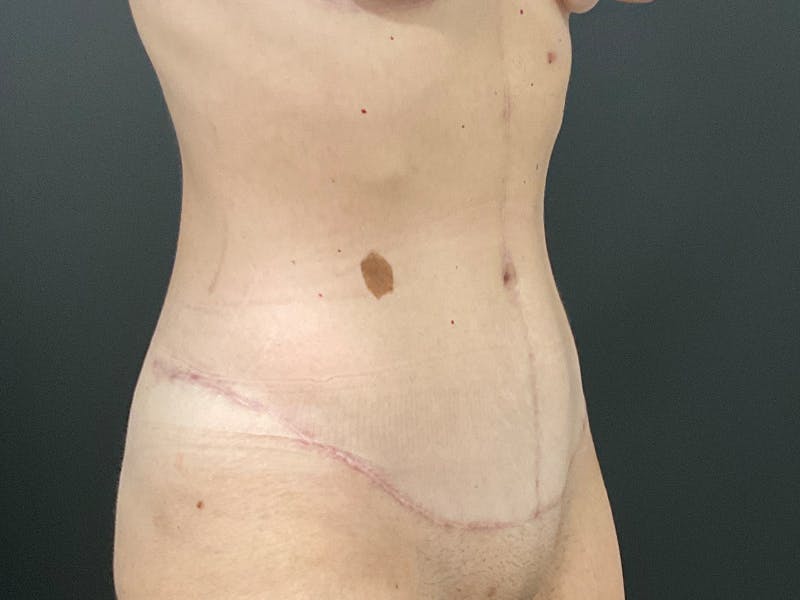 Tummy Tuck Before & After Gallery - Patient 318654 - Image 4