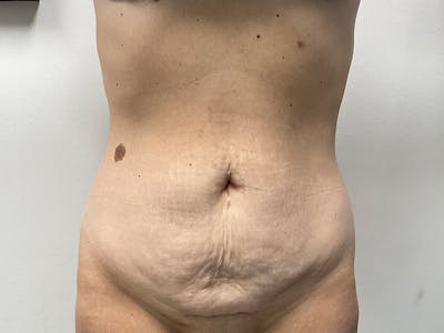 Tummy Tuck Before & After Gallery - Patient 318654 - Image 1
