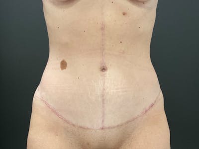 Tummy Tuck Before & After Gallery - Patient 318654 - Image 2